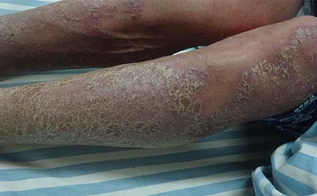 沈阳银屑病医院讲银屑病是由哪些因素导致的