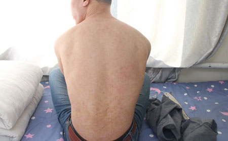 感染诱发银屑病防治日常