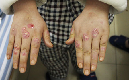 分享如何治疗手部银屑病呢图片