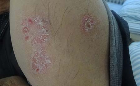 怎么降低男性银屑病遗传概率