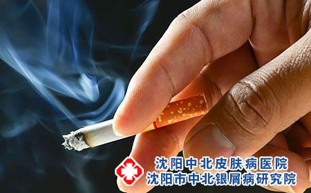 牛皮癣的危害有哪些?可以吸烟吗?