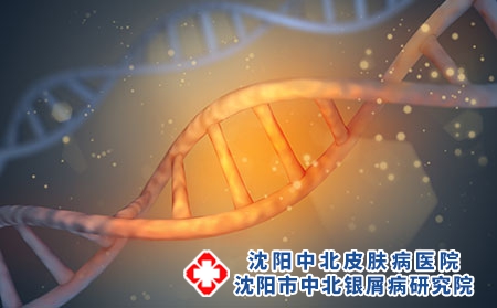 银屑病患者可以吃黄芪吗