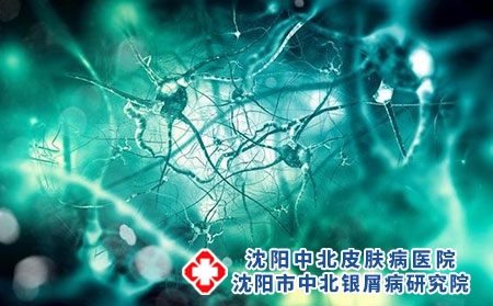 牛皮癣会传染孩子吗?用药常识有哪些?