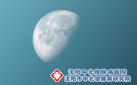 牛皮癣吃什么比较好?