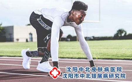 牛皮癣治疗的三大误区精神压力有影响吗?