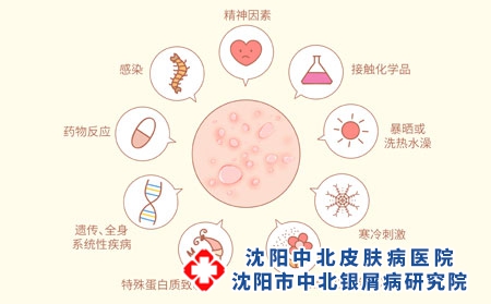 牛皮癣患者可以通过血常规来进行检查病情吗