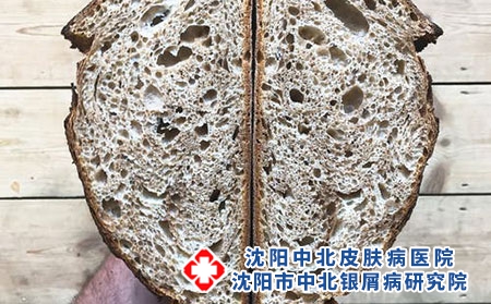 银屑病会遗传吗?秋季饮食需要注意什么?