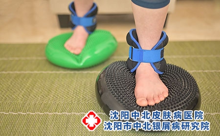 牛皮癣身体表面的症状消失了是治好了吗