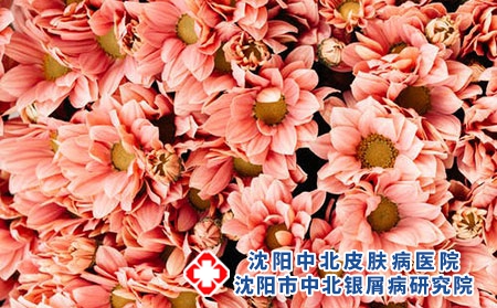 牛皮癣不同时期的症状有哪些?