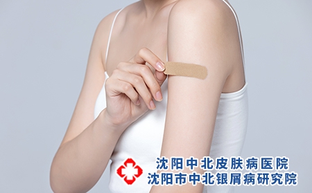 女性患者治疗银屑病有哪些方法