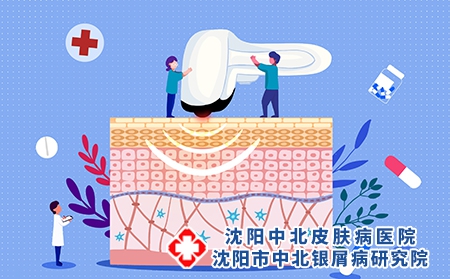 银屑病患者做光疗的效果如何