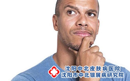 牛皮癣会不会遗传?患了牛皮癣怎么办?