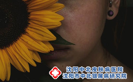 沈阳治银屑病哪家医院好?