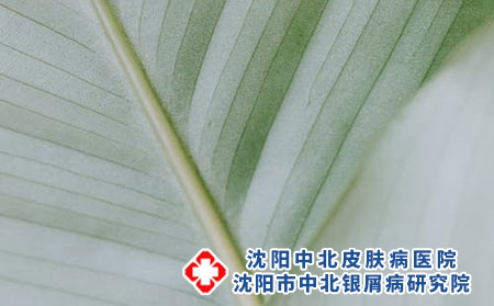 沈阳银屑病患者需要心理治疗吗