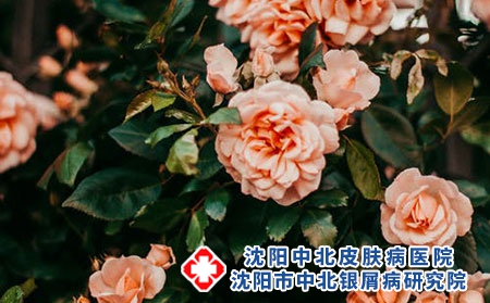 银屑病患者如何正常用药