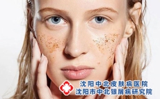 加重牛皮癣的因素有哪些?