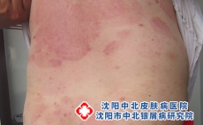 儿童银屑病的生活护理，沈阳治银屑病电约沈阳中北