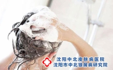 头部银屑病患者洗头时应该注意什么