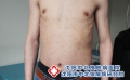 脓疱型银屑病患者皮肤保养指南?