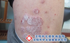 沈阳做些什么来避免银屑病复发,沈阳银屑病中北名杰出