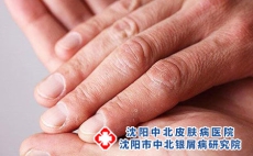 手部牛皮癣常识有哪些?