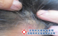 头皮银屑病和脂溢性皮炎区别，沈阳中治疗银屑病