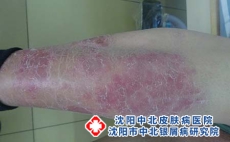 牛皮癣治疗价格是多少