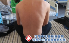 银屑病用什么药膏抹身上？