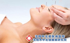 得了头部牛皮癣要及早治疗