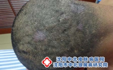 2026最新寻常型银屑病结痂能扣吗？医生建议：实用秘诀分享