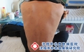 银屑病能要孩子吗？沈阳中北医院医师指导：实用秘诀分享