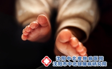 儿童银屑病运动有什么好处?