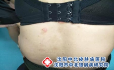 银屑病患者能游泳吗，沈阳医治银屑病好的医院