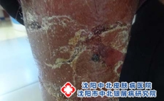牛皮癣日常保健应该走好哪四步