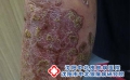 银屑病为什么不能乱忌口 啥都不敢吃反而越养越差
