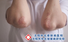 寻常型银屑病是过敏吗