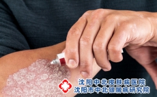 牛皮癣老了会更严重吗？