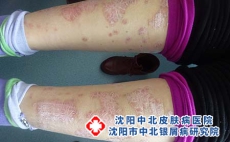 沈阳治疗牛皮癣花费高吗