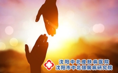 照光能治疗头部牛皮癣吗？