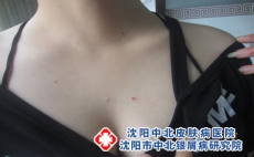 银屑病对患者有什么危害，沈阳银屑病医院医保