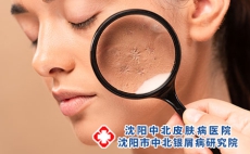 牛皮癣与玫瑰糠疹的鉴别。