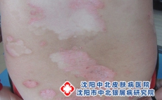 牛皮癣皮肤护理怎么做，沈阳市好点的牛皮癣医院