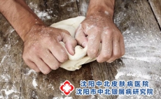 银屑病患者夏季如何调理肠胃