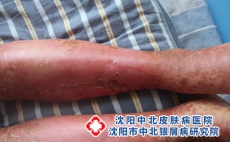 牛皮癣的危害有哪些，沈阳治疗牛皮癣哪个医院好?