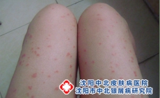 银屑病患者该怎么吃，沈阳牛皮癣可以痊愈吗