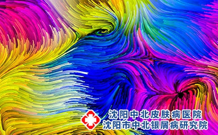 哪些不良因素会导致牛皮癣患者复发?