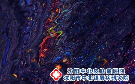 沈阳治银屑病的医院：怎样治疗牛皮癣有好的治疗效果?