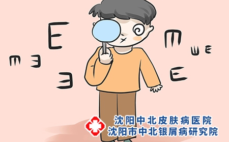 沈阳哪家医院看牛皮癣好?点状牛皮癣如何治疗好