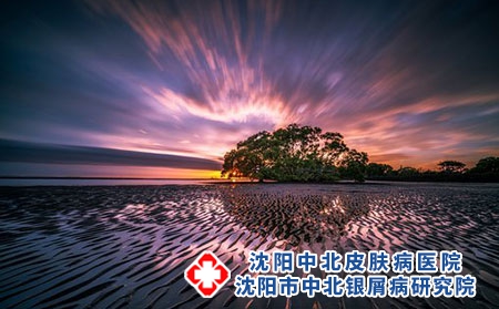 [沈阳哪里医院牛皮癣治疗好]得了银屑病该怎么办才好呢