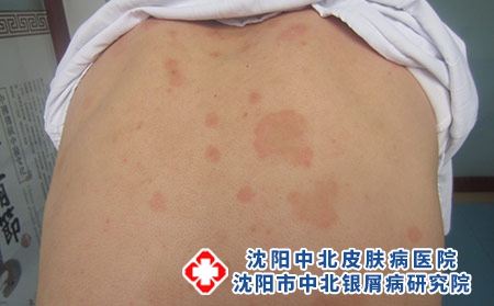 为什么外伤更容易导致银屑病，沈阳牛皮癣医院看银屑病哪家正规